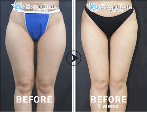 Thigh & Hip Liposuction Evita Clinic