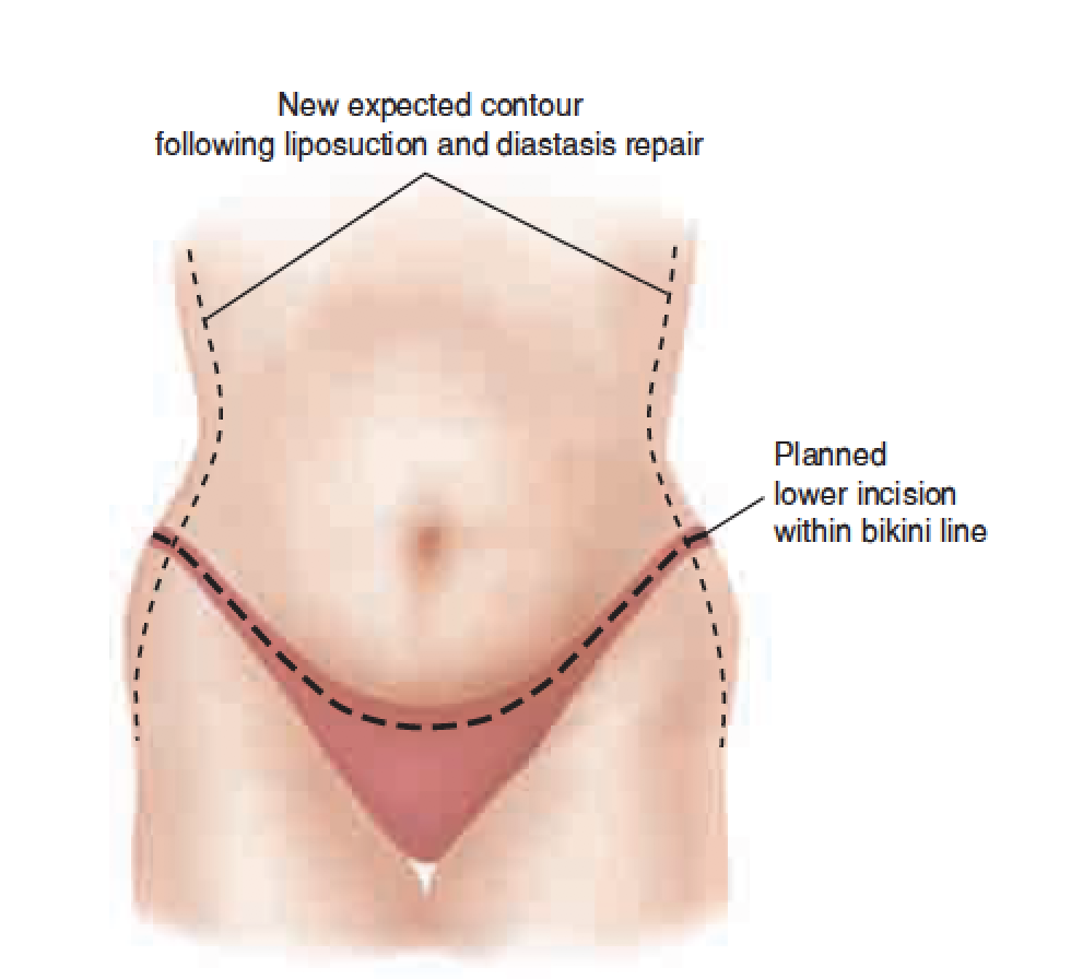 Abdominoplasti-Tummy Tuck - Invictus Health Advisor