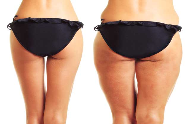 Thigh & Hip Liposuction Evita Clinic