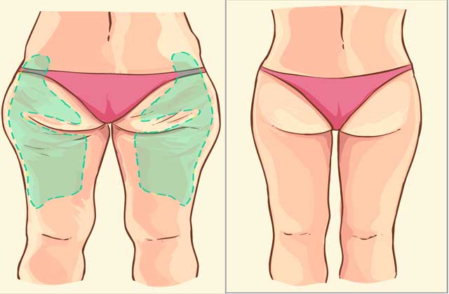 Thigh & Hip Liposuction Evita Clinic