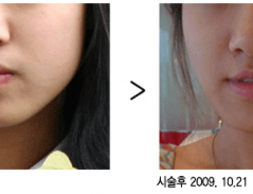 Massector Muscle (Jaw Line) BTx-A
