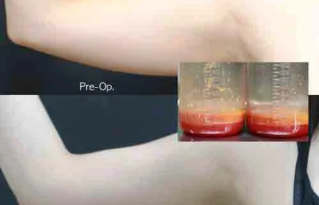 Arm liposuction before and after 3 weeks female upper arm fat reduction result