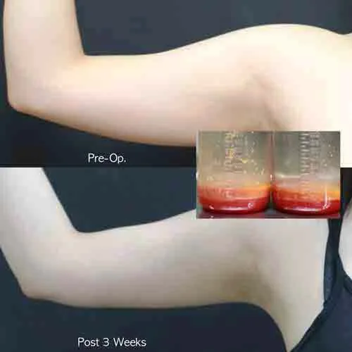Arm liposuction before and after 3 weeks female upper arm fat reduction result