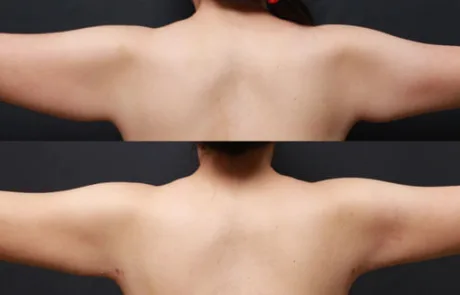 Arm liposuction before and after in a 32-year-old female with postpartum skin laxity, 1 month results