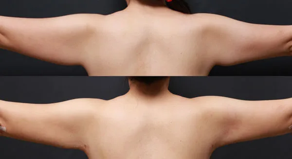 Arm liposuction before and after in a 32-year-old female with postpartum skin laxity, 1 month results