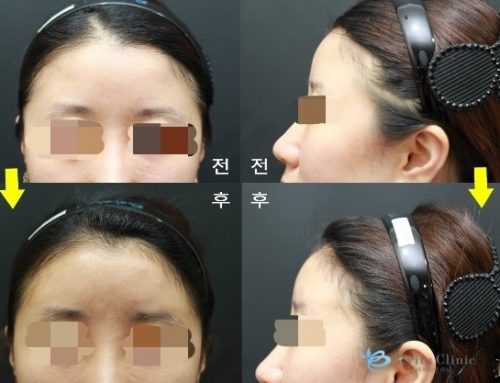 Forehead Filler