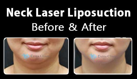 Neck Liposuction