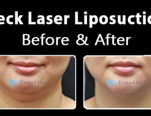 Neck Liposuction, 42/F