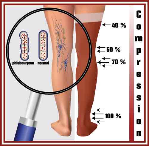 Compression therapy for outlet varicose veins