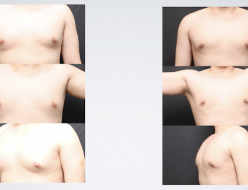 Gynecomastia