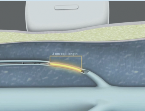 Variable Treatments of Varicose Vein