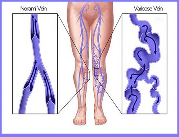 Evita Clinic Mechanism of Varicose Veins