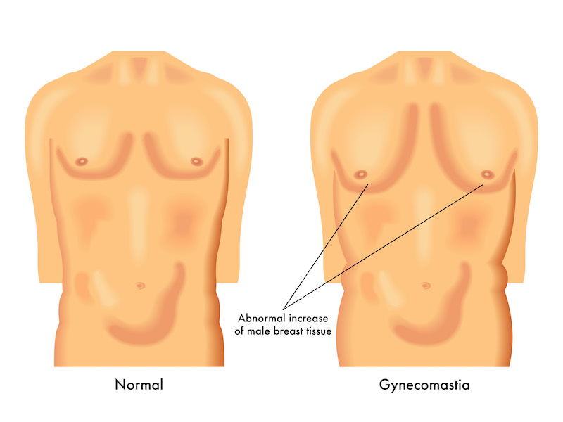 What Causes Male Breasts, Man Boobs or Gynecomastia?