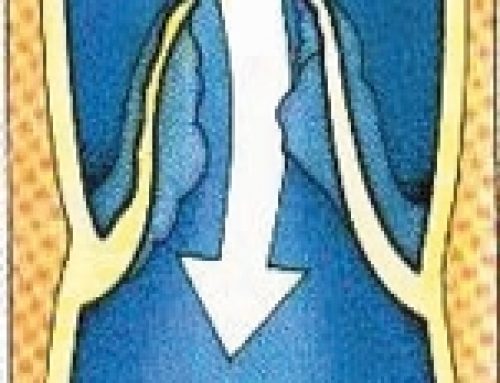 Mechanism of Varicose Veins