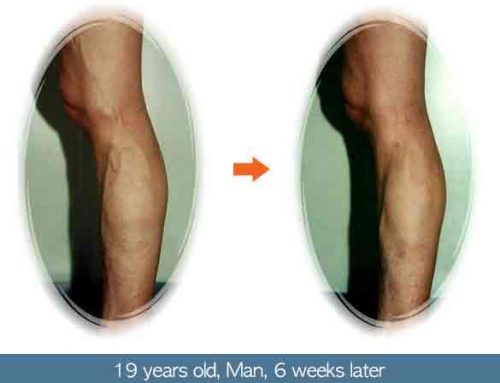 Phlebectomy & Sclerotherapy