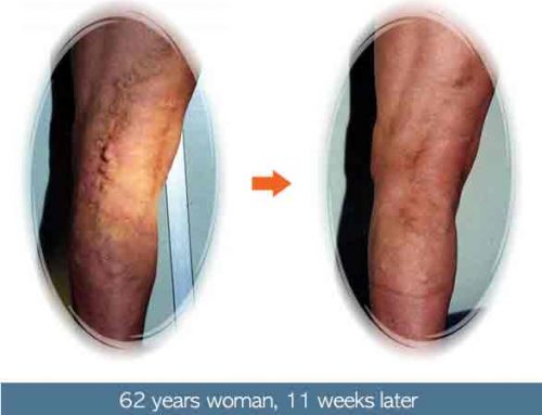 Varicose Vein – EVLT