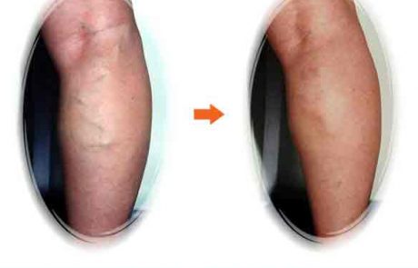 Sclerotherapy 50 F 8w