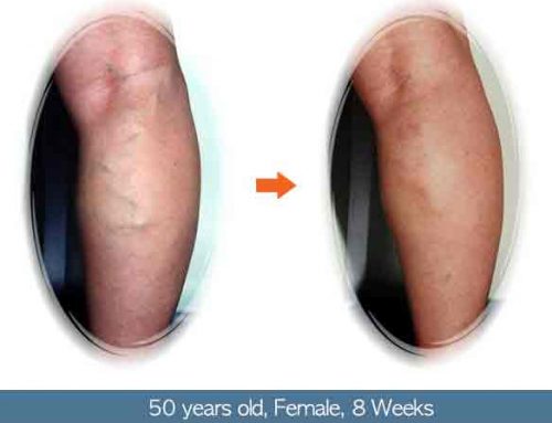 8 Weeks After Sclerotherapy,