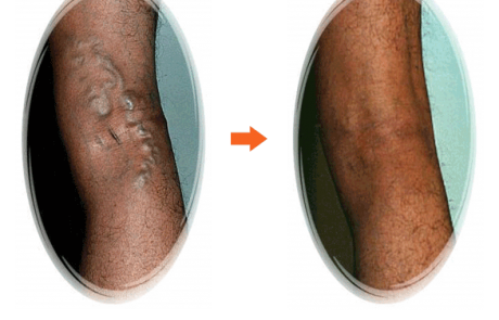Varicose Vein 36 M 4