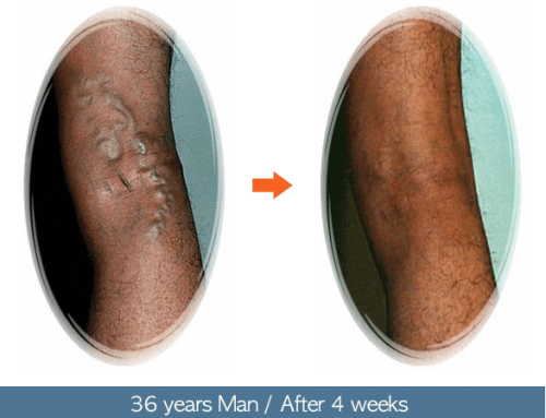 After Phlebectomy