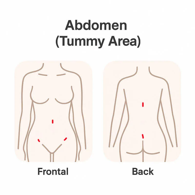 liposuction_incision_abdomen