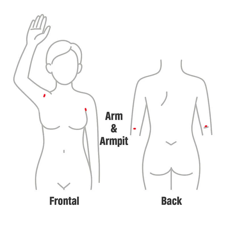 liposuction_incision_arm