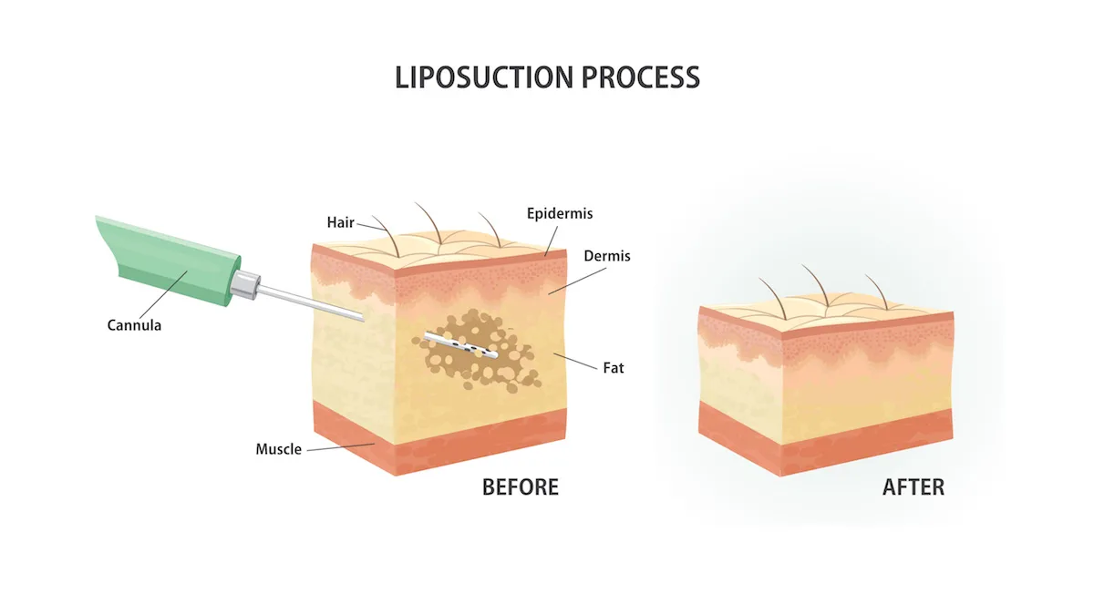 liposuction_procedure