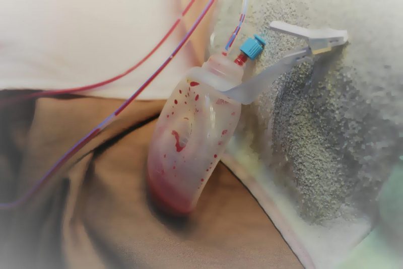 Patient wearing a surgical drain after surgery