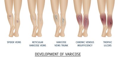 Varicose Vein - Evita Clinic