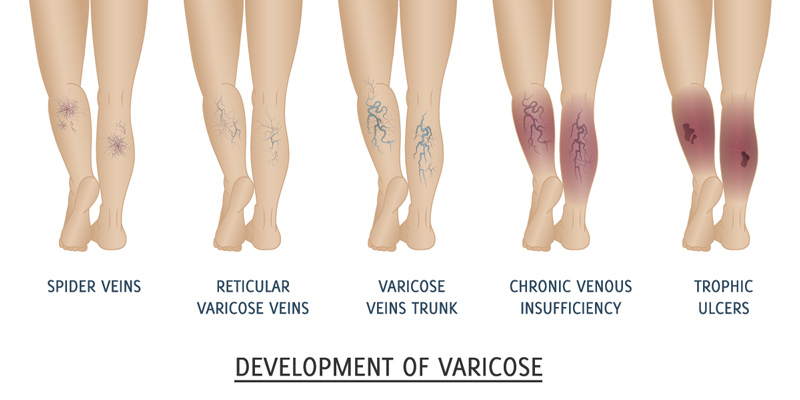 Varicose Veins: What You Need to Know - Evita Clinic %