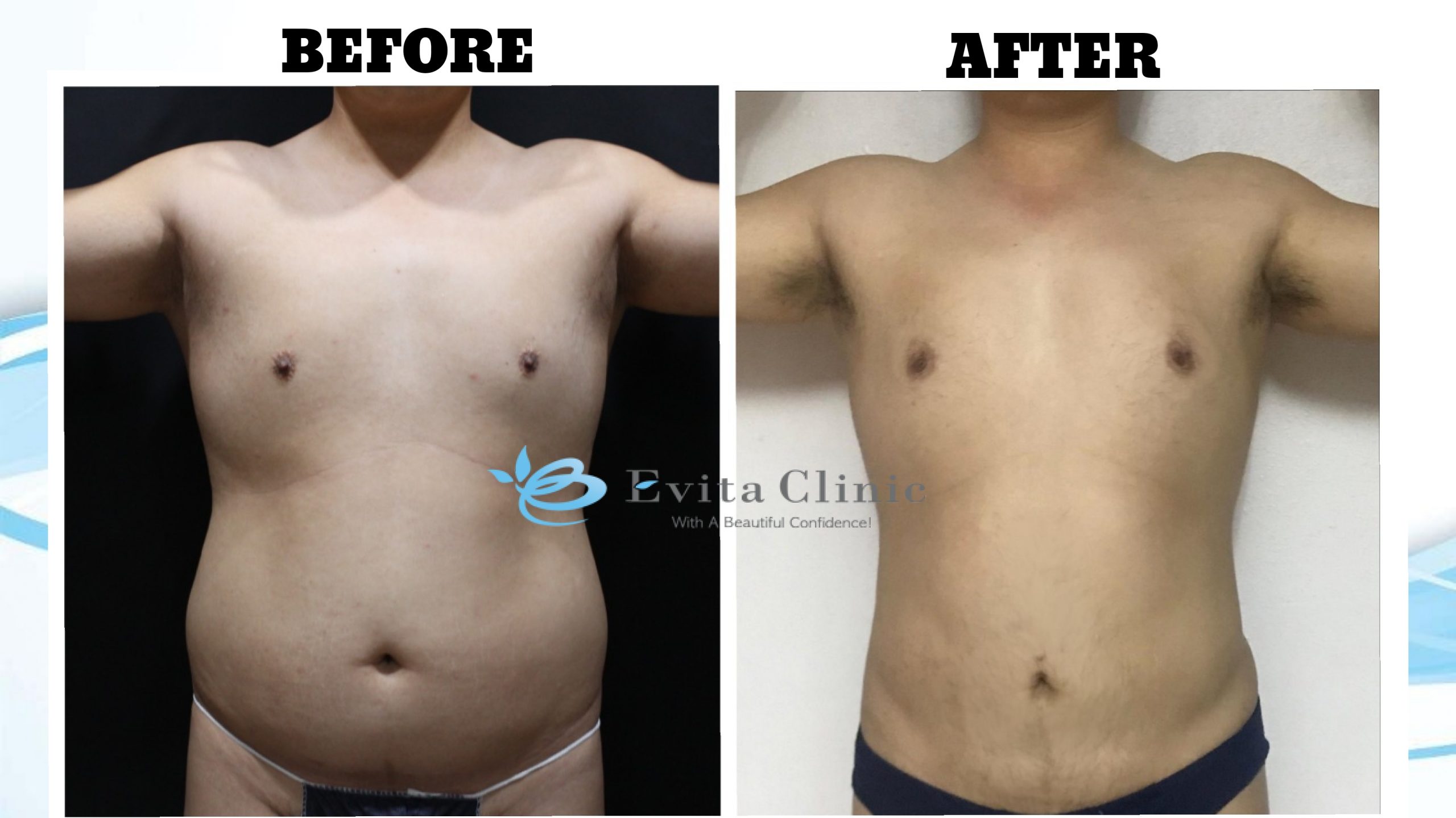 Liposuction Seoul Korea - Body Contouring