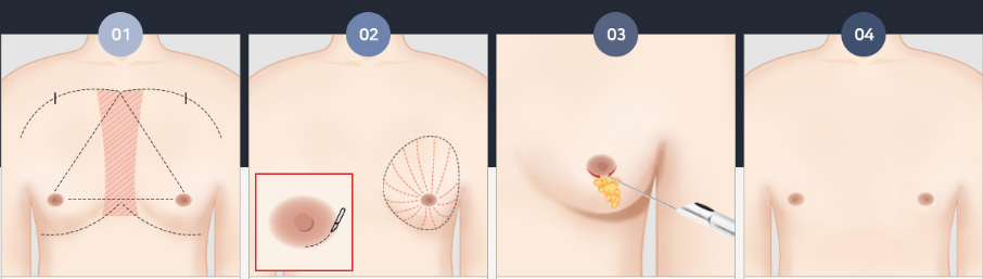 Breast Augmentation Surgery For Saggy Breasts? – Eunogo