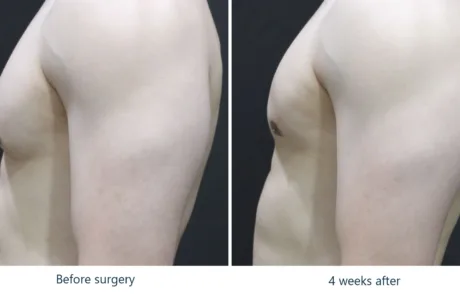 gynecomastia glandular excision before after side 4w 202111
