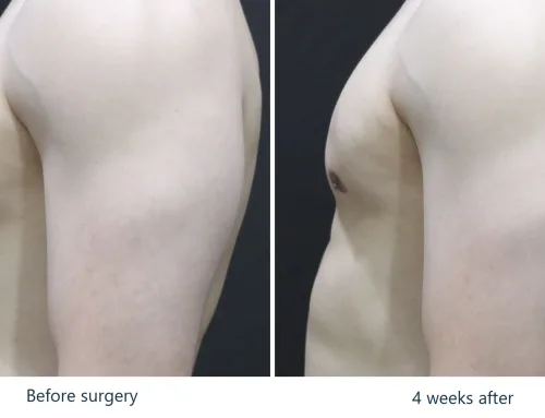 Gynecomastia (Grade 2) – 4 Weeks After Surgery