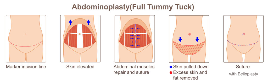 What Is Mini Tummy Tuck? + [Mini vs Full Tummy Tuck] - Raadina Health