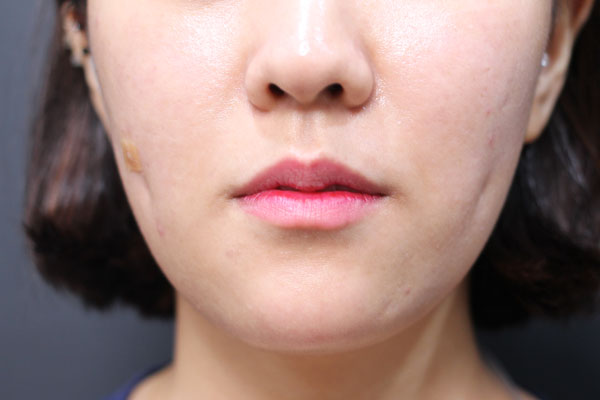 Front view immediately after bilateral cheek dimpleplasty