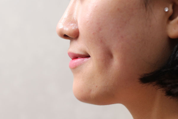 Oblique view immediately after cheek dimpleplasty