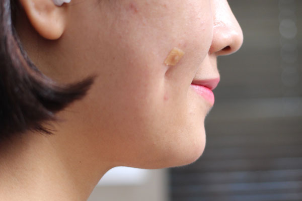 Side view of early cheek indentation after dimpleplasty