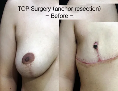TOP Surgery, anchor resection