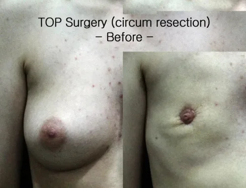 TOP Surgery, circumareolar resection