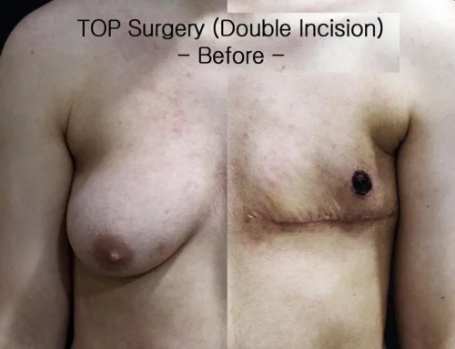 TOP Surgery, double incision