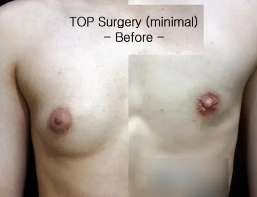 TOP Surgery, minimal incision