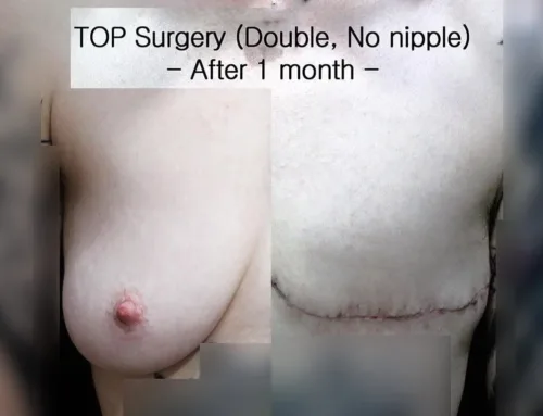 TOP Surgery, nonbinary, double incision