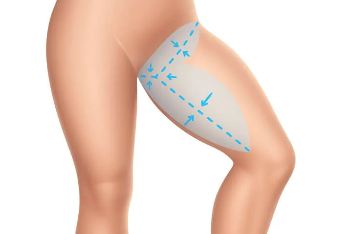 thighlift_01