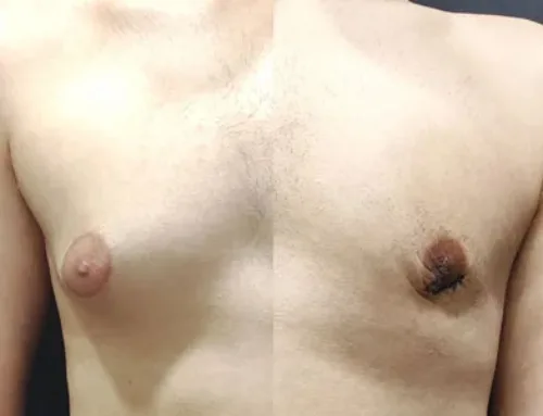 Gynecomastia, Grade 2, 20yrs