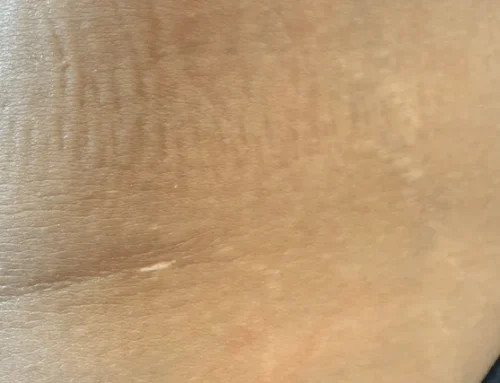 What Do Liposuction Scars Really Look Like?