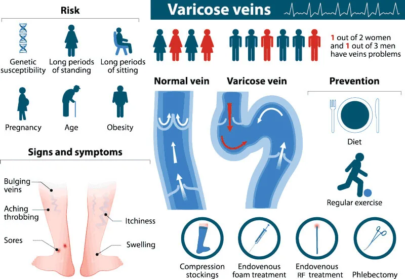 Varicose_Vein_Inform Infographic explaining varicose veins, showing risk factors, symptoms, comparison of normal vs. varicose veins, and common prevention and treatment methods.