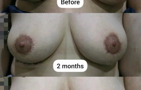 Areola reduction before surgery and postoperative results at 2 months and 4 months after circumareolar areola reduction surgery