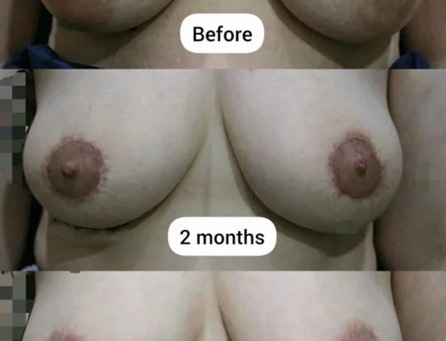 Areola Reduction (Circumareolar Technique)
