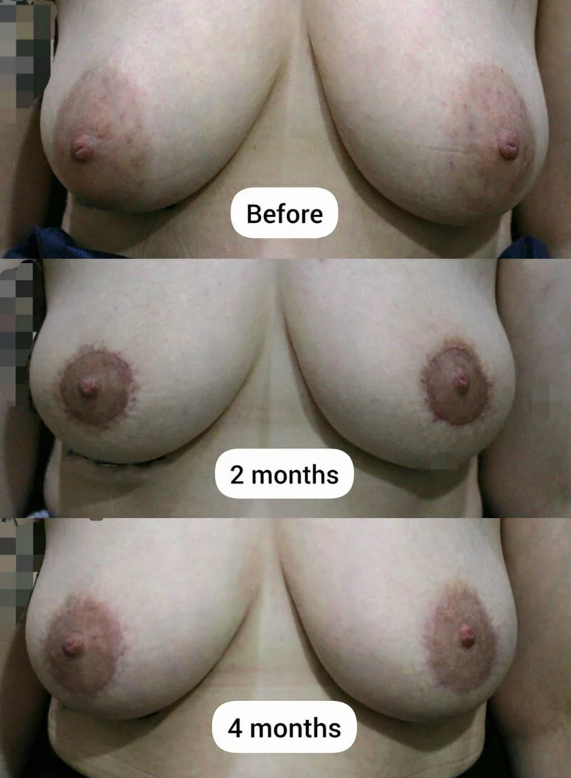 Areola reduction before surgery and postoperative results at 2 months and 4 months after circumareolar areola reduction surgery